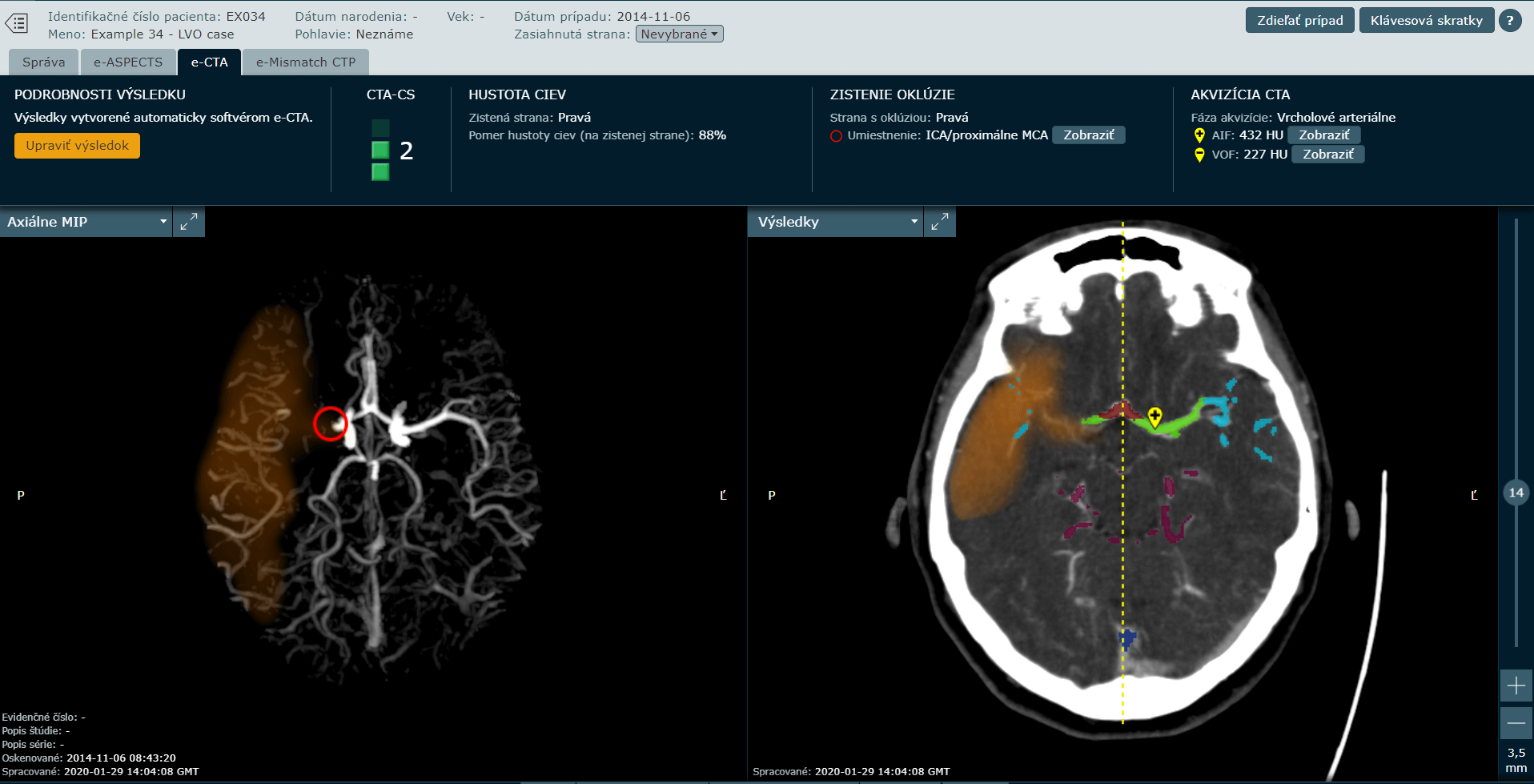 neurovaskularny program brainomix