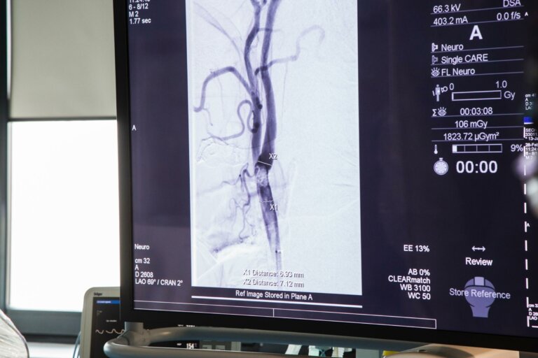 nemocnica-bory.sk_CINRE-karoticky stenting8-2